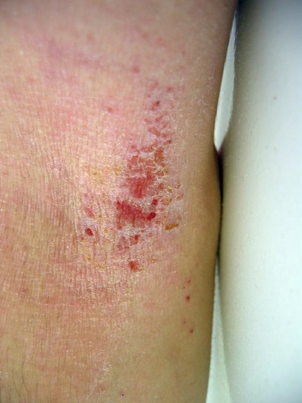 skin disorders pictures #11