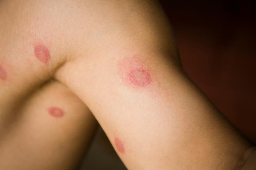 What causes a rash behind the knees?