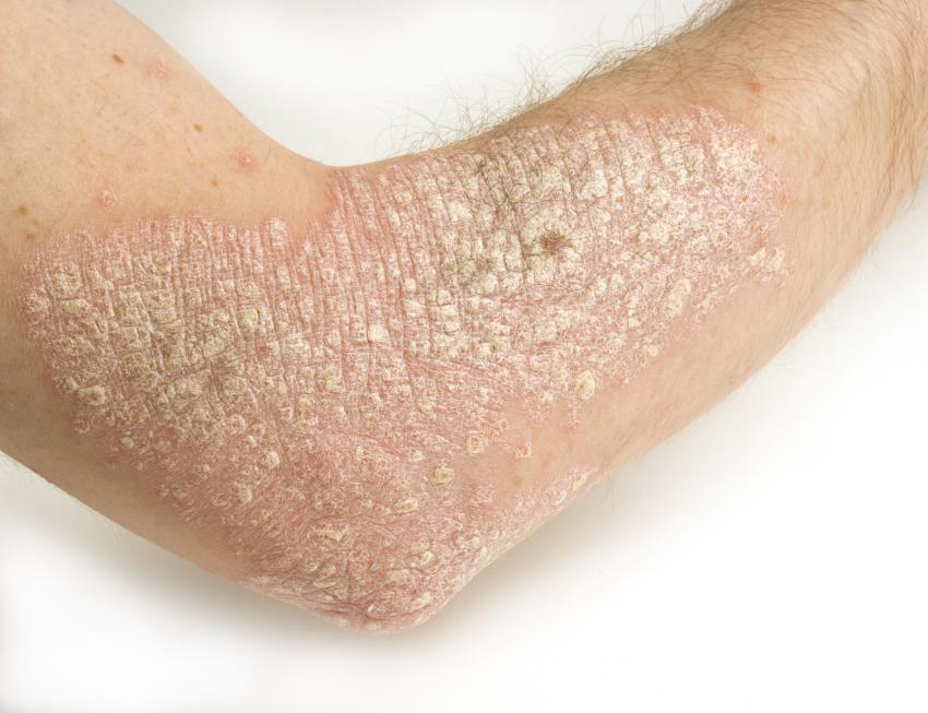 Skin rash arm