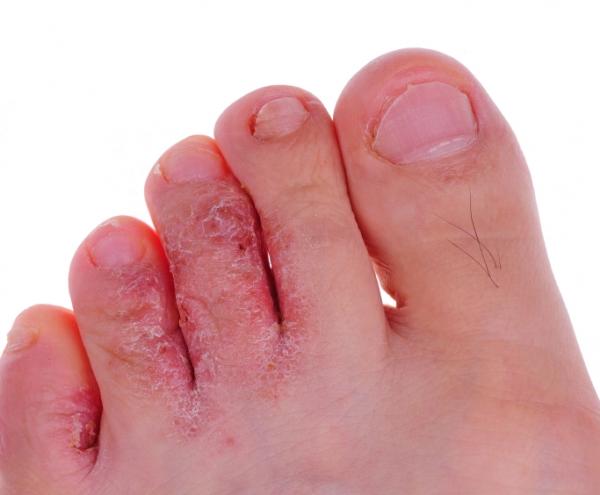 The result of fungus penetrating toe nails.