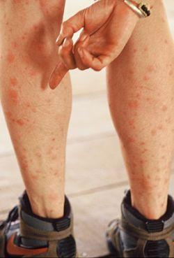 Man with numerous mosquito bites