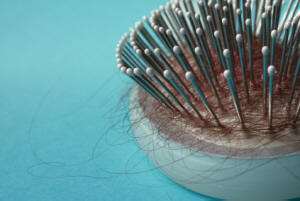 Hair loss disease - Alopecia Areata