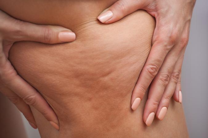 woman grabbing thigh with cellulite