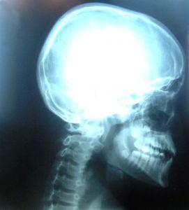 Tumors Caused by Cell Phones