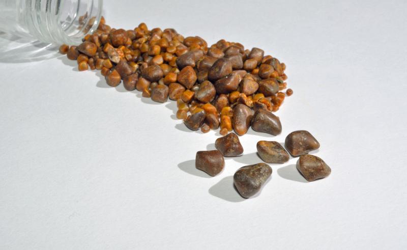Gallstones and specimen jar