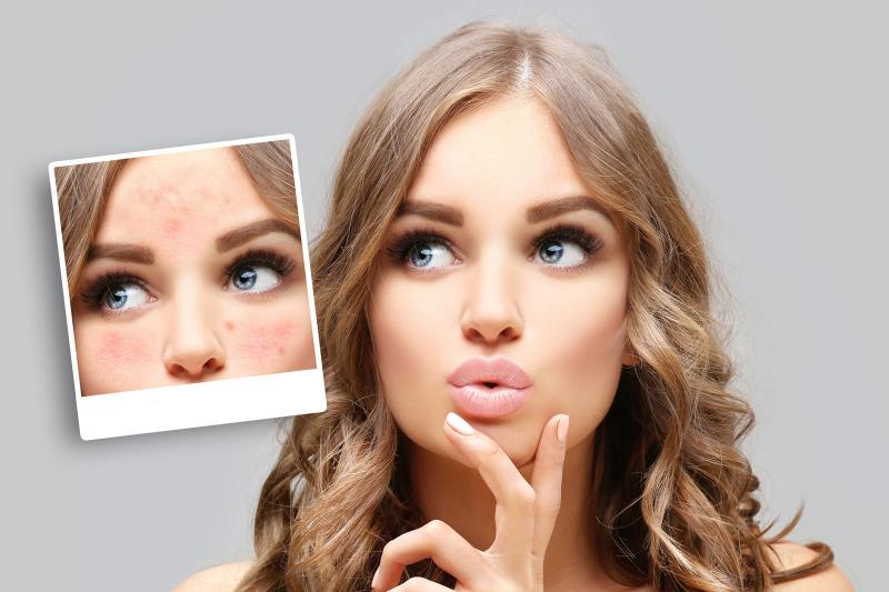 Foods to Eat for Rosacea LoveToKnow Health & Wellness