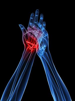 Hands with gout