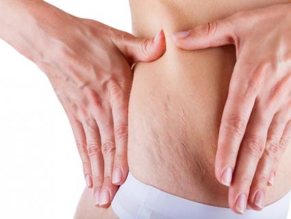 Slender woman with stretch marks