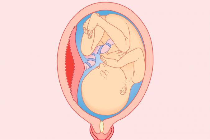 Revestimiento de la placenta separado del útero