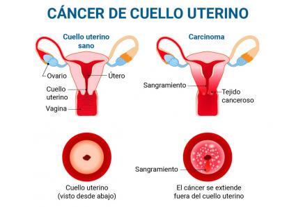 pequeña mancha en el utero