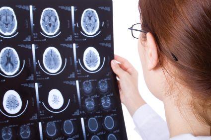 Neurological Effects of Gluten Sensitivity
