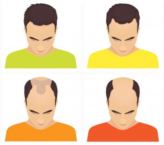 Hair loss stages in men