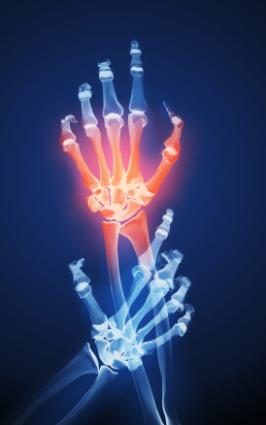 Inflamed joints in hand.