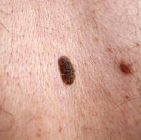 Warts and Moles