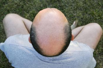 Baldinghead.jpg