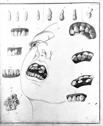 Dientes supernumerarios