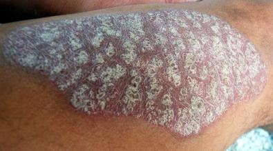 Psoriasis.jpg
