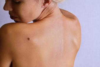 Woman looking at birthmark on back