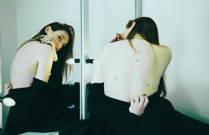 Woman with birthmarks