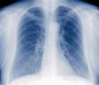 lung xray