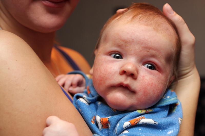 Baby with eczema on face