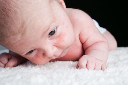 Baby with milia skin condition