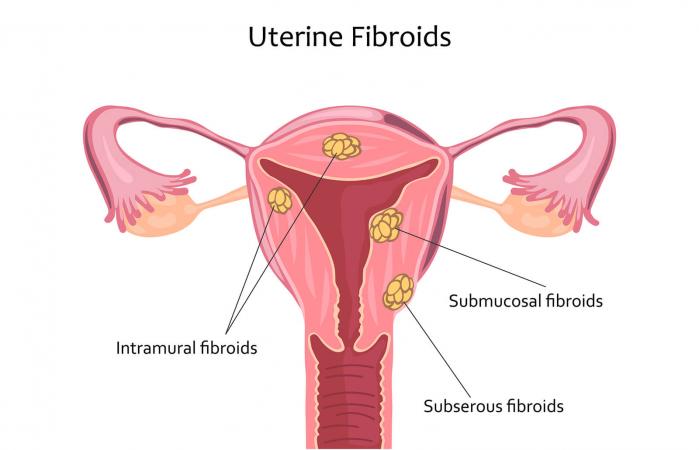 Uterine Fibroids