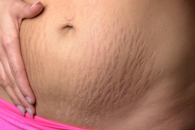 belly with stretch marks