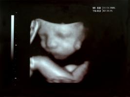 Ultrasound image of developing fetus