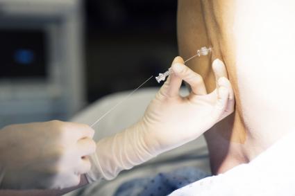 Epidural anesthesia
