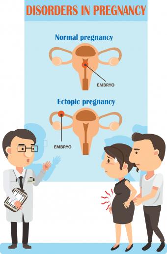 Ectopic pregnancy illustration