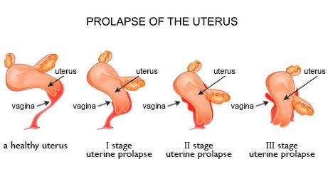 Prolapse of the uterus