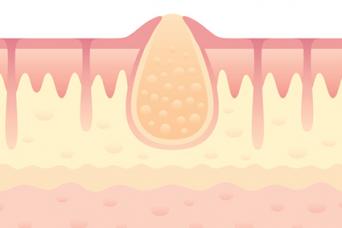 Skin Abscess