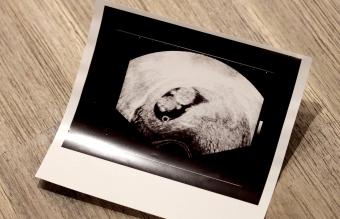 8-Week Pregnancy Ultrasound