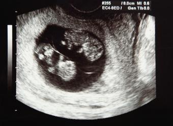 ultrasound of twins