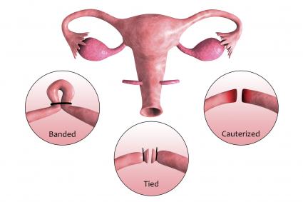 Biomedical illustration of a tubectomy