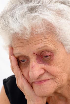 Senior woman with a black eye
