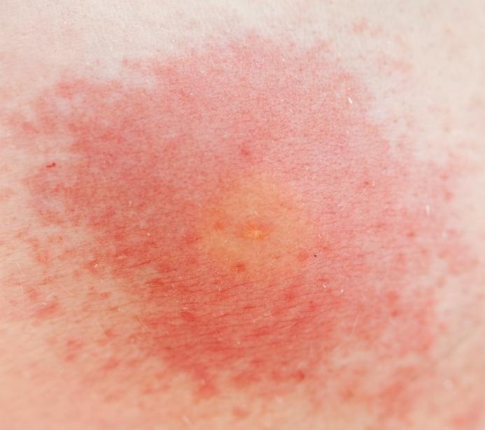 Pictures of Skin Rashes | LoveToKnow Health & Wellness