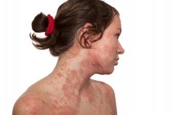Pictures of Skin Rashes