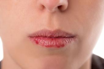 Woman with dry lips