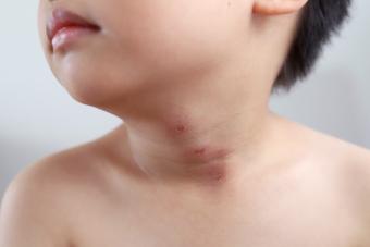 Chigger Bites on little kid