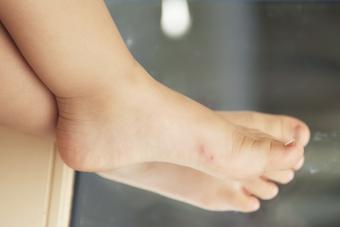 Toddler feet with fire ant bites