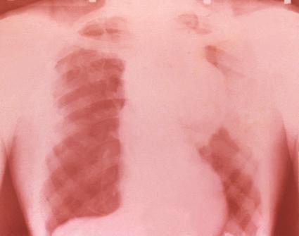 Chest Xray