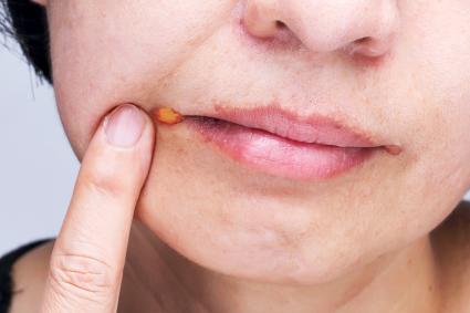 Angular cheilitis