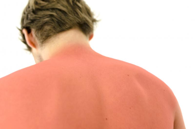 Severe sunburn
