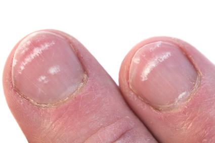finger nail Problem