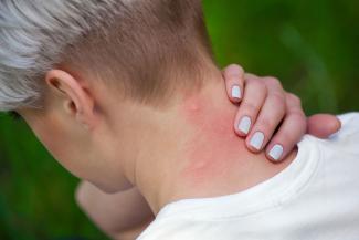 Mosquito bites to the neck