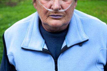 Man with blue lips due to COPD