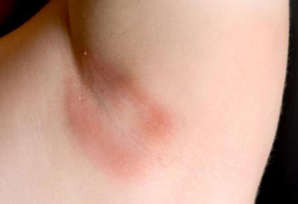 Armpit yeast infection
