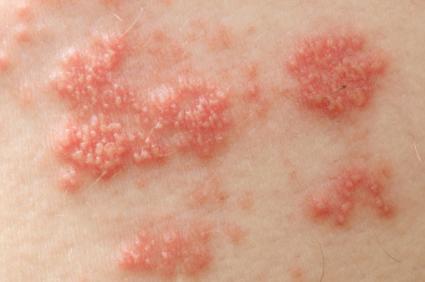 Rash caused by the shingles virus